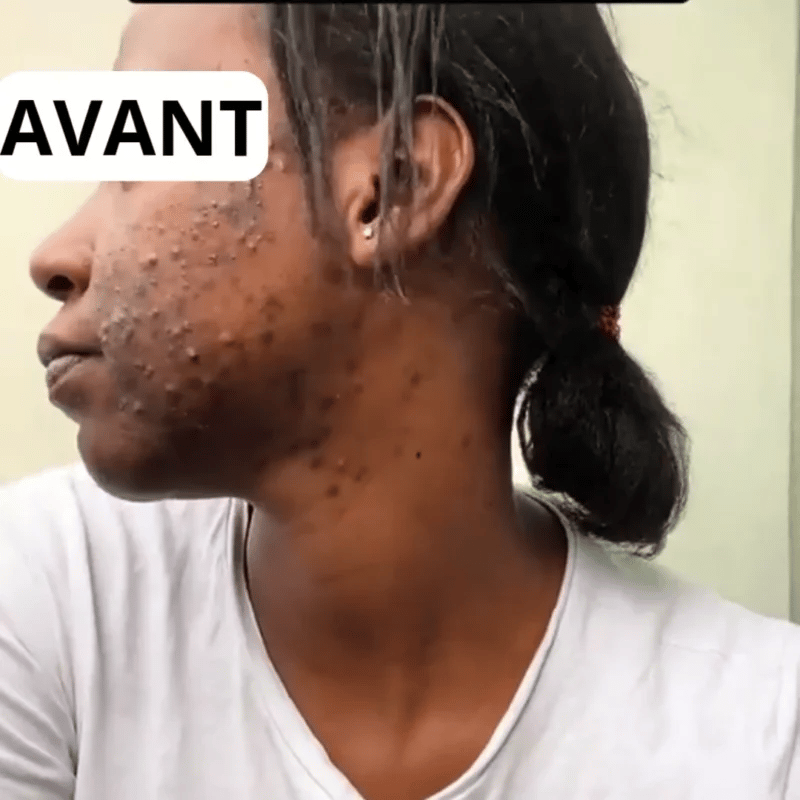 Crème réparatrice anti-cicatrices et vergetures - VivaLok™